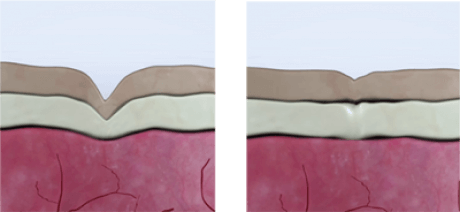 absolutebodyspecialistscoolifting-dermis-skin-2d82e683
