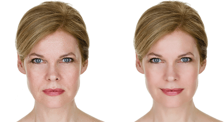 absolutebodyspecialistscoolifting-dermis-women