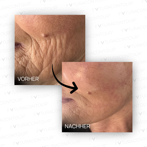 VN 1